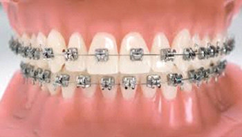 Tratamiento de Ortodoncia en la Clinica dental Carvajal de Jaen