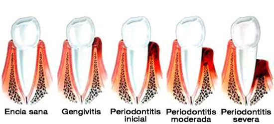 Tratamientos de periodoncia en Clinica dental Carvajal de Jaen
