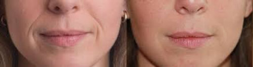 Tratamiento de Estetica dental en la Clinica dental Carvajal de Jaen