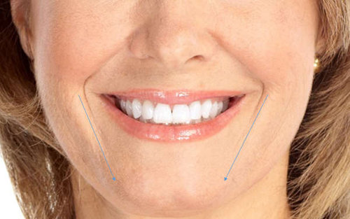 Tratamiento de Estetica dental en la Clinica dental Carvajal de Jaen