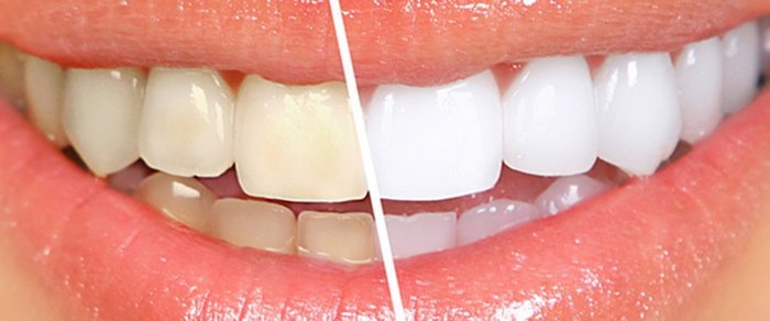 Odontologia estetica y blanqueamiento dental en Clinica dental Carvajal de Jaen