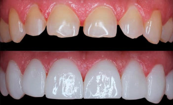 Tratamiento de Estetica dental en la Clinica dental Carvajal de Jaen