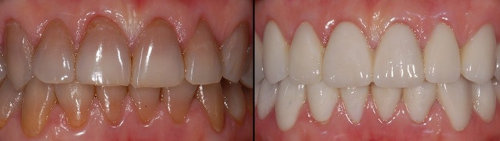 Tratamiento de Estetica dental en la Clinica dental Carvajal de Jaen