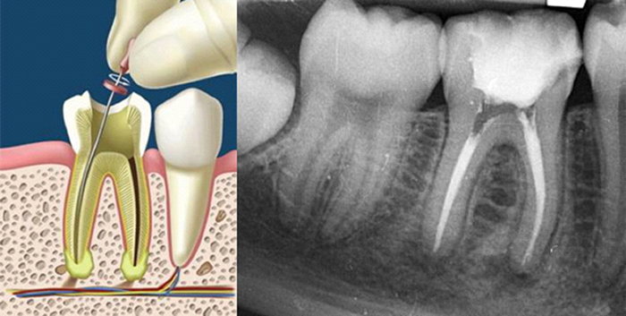 Tratamiento de endodoncia en Clinica dental Carvajal de Jaen