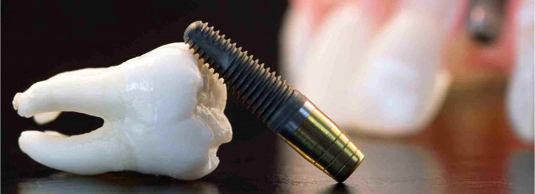 Implantologia dental en la Clinica dental Carvajal de Jaen