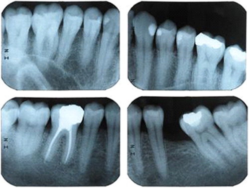 Odontologia Preventiva en Clinica dental Carvajal de Jaen