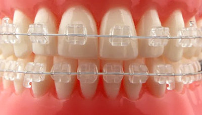 Tratamiento de Ortodoncia en la Clinica dental Carvajal de Jaen