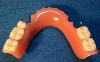 Prótesis removibles en Clinica dental Carvajal de Jaen