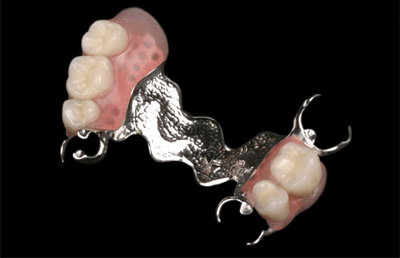 Prótesis removibles en Clinica dental Carvajal de Jaen