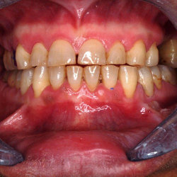 Tratamiento Snap on Smile en Clinica dental Carvajal de Jaen