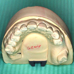 Tratamiento Snap on Smile en Clinica dental Carvajal de Jaen