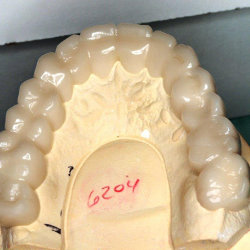 Tratamiento Snap on Smile en Clinica dental Carvajal de Jaen