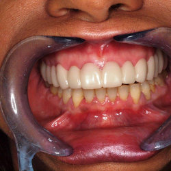 Tratamiento Snap on Smile en Clinica dental Carvajal de Jaen