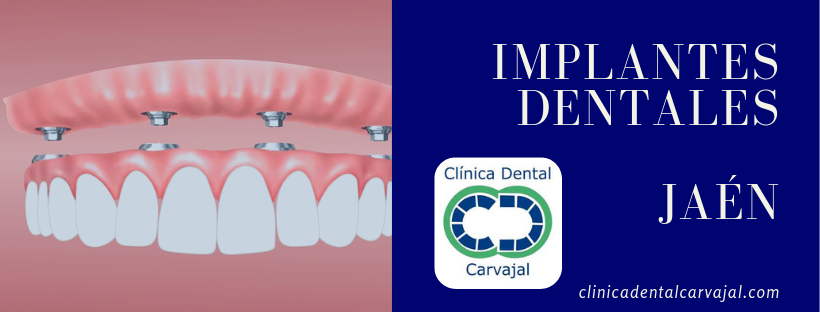 Implantes Dentales en Jaén