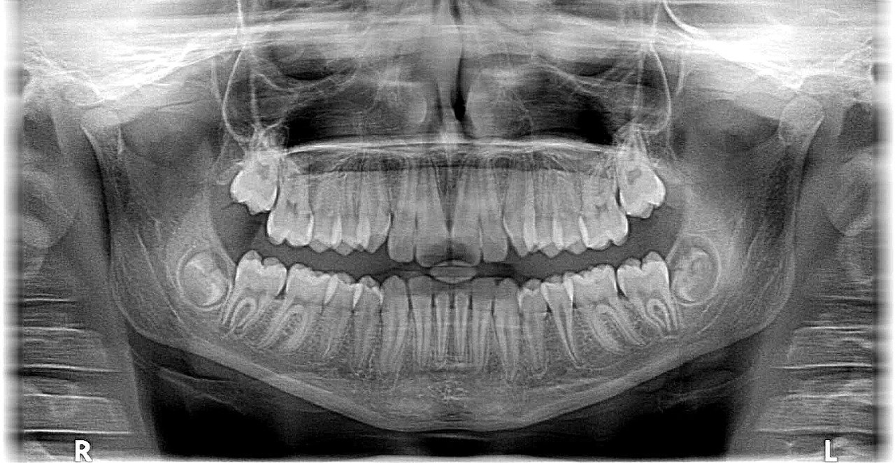 Tipos de radiografías dentales en Jaén, Clínica Dental Carvajal